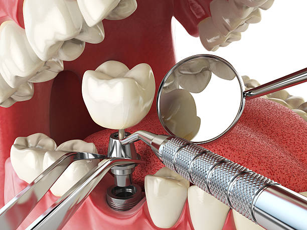 Best Emergency Tooth Extraction in Georgetown, DE